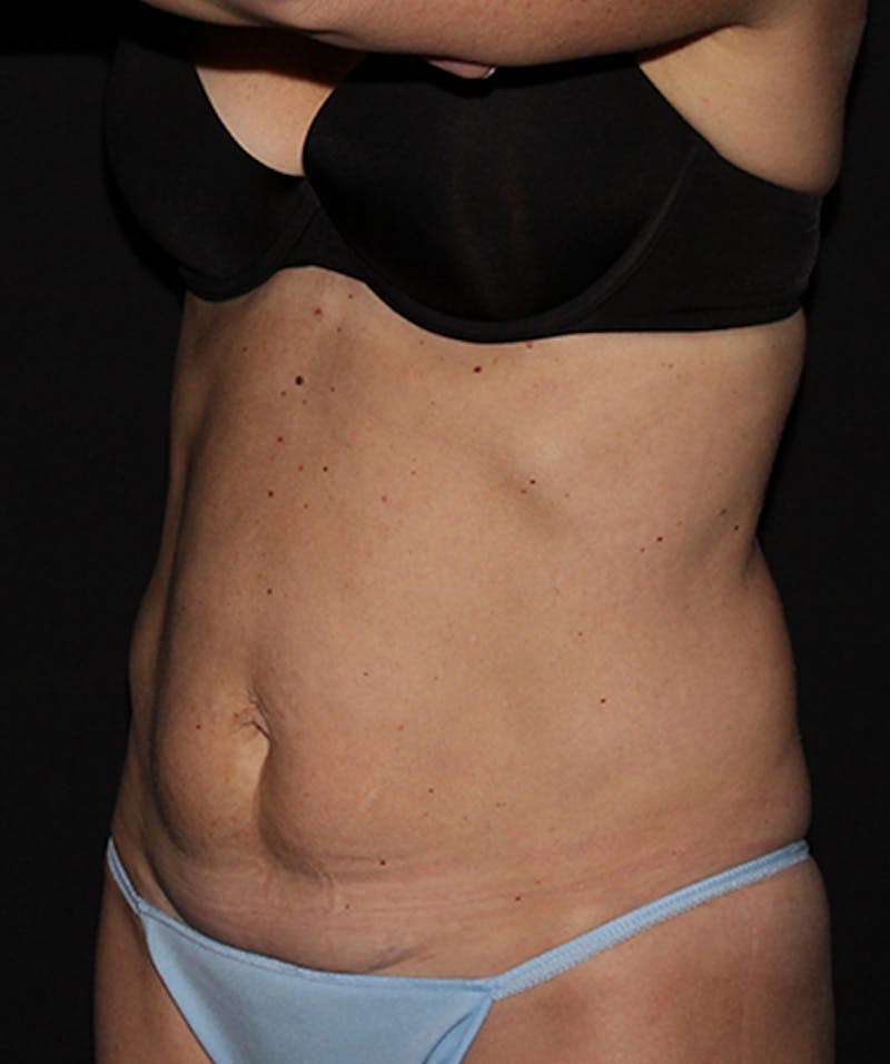 Tummy Tuck Before & After Gallery - Patient 133023942 - Image 3