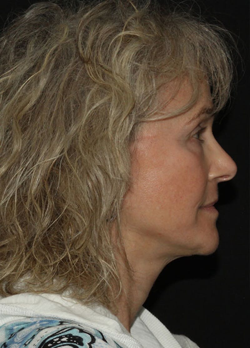 Facelift & Necklift Before & After Gallery - Patient 133023930 - Image 6