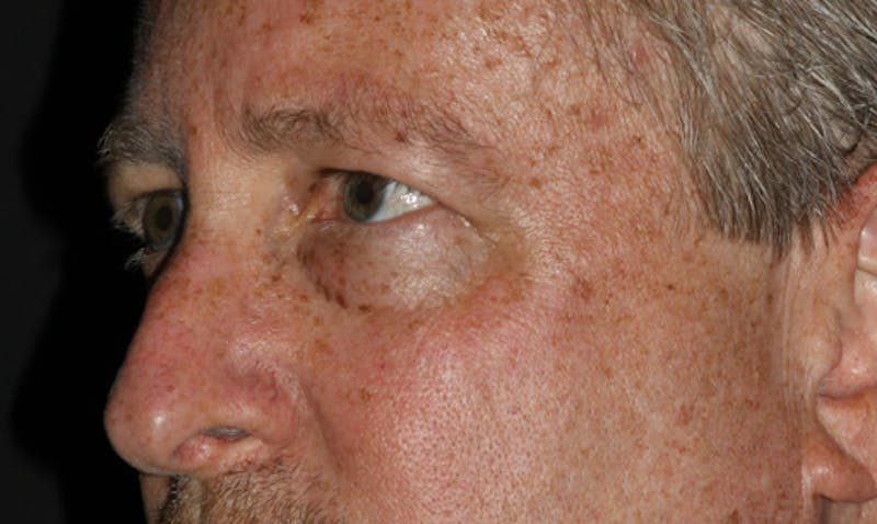 Eyelid Surgery Before & After Gallery - Patient 133023931 - Image 5