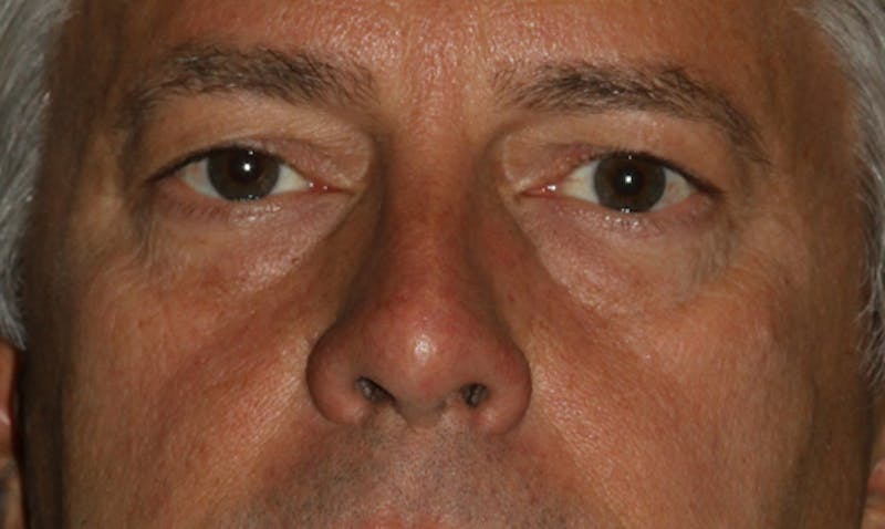 Eyelid Surgery Before & After Gallery - Patient 133023939 - Image 1