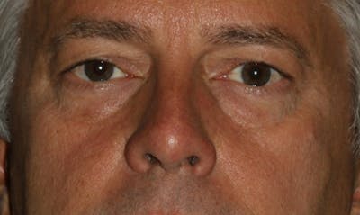 Eyelid Surgery Before & After Gallery - Patient 133023939 - Image 1