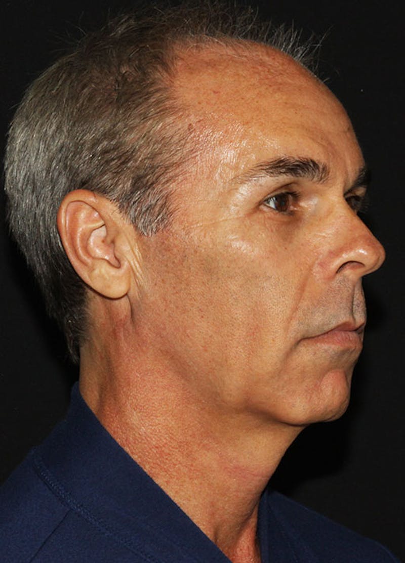 Facelift & Necklift Before & After Gallery - Patient 133023934 - Image 3