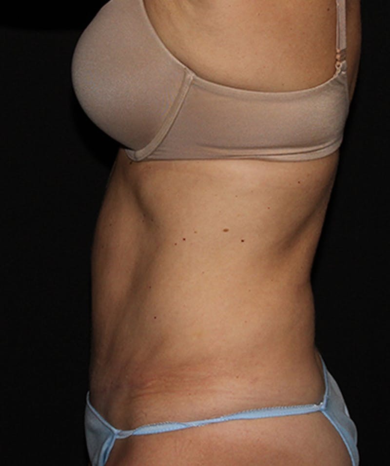 Tummy Tuck Before & After Gallery - Patient 133023942 - Image 6
