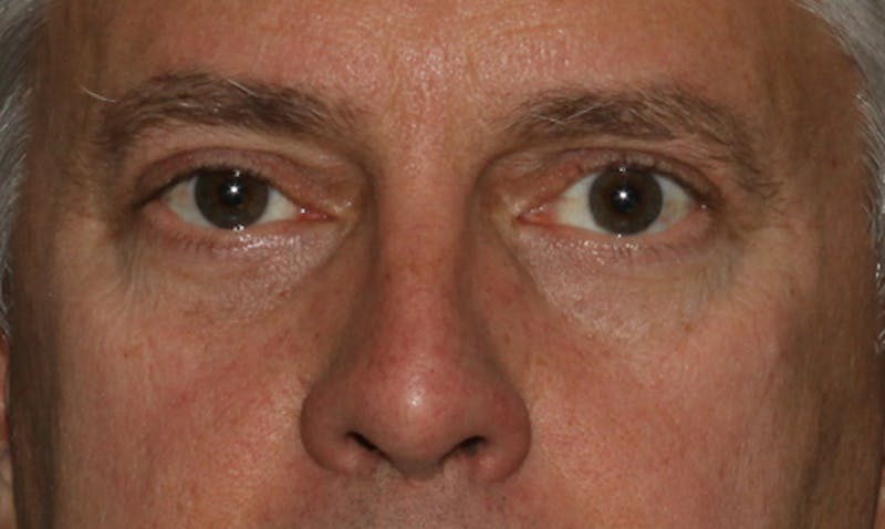 Eyelid Surgery Before & After Gallery - Patient 133023939 - Image 2