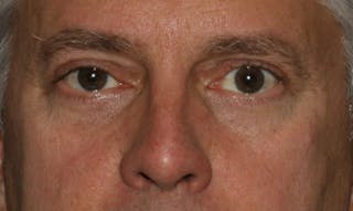 Eyelid Surgery Before & After Gallery - Patient 133023939 - Image 2