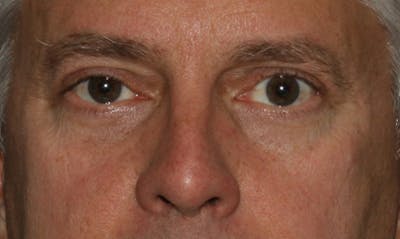 Eyelid Surgery Before & After Gallery - Patient 133023939 - Image 2