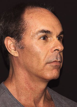 Facelift & Necklift Before & After Gallery - Patient 133023934 - Image 4