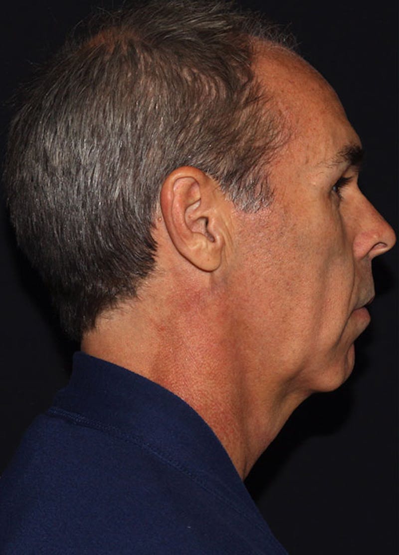 Facelift & Necklift Before & After Gallery - Patient 133023934 - Image 5