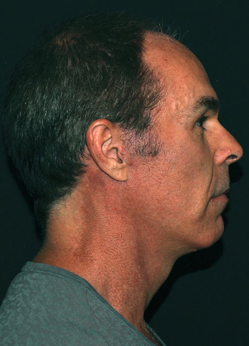 Facelift & Necklift Before & After Gallery - Patient 133023934 - Image 6