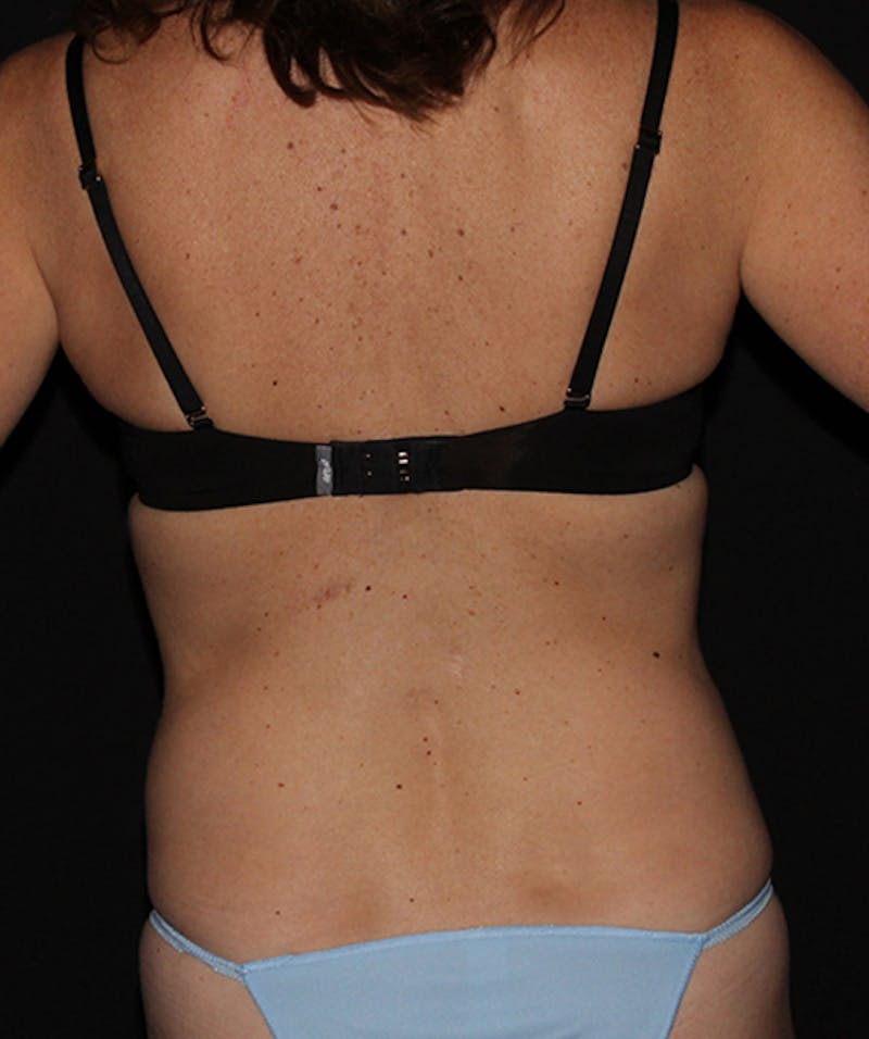 Tummy Tuck Before & After Gallery - Patient 133023942 - Image 11