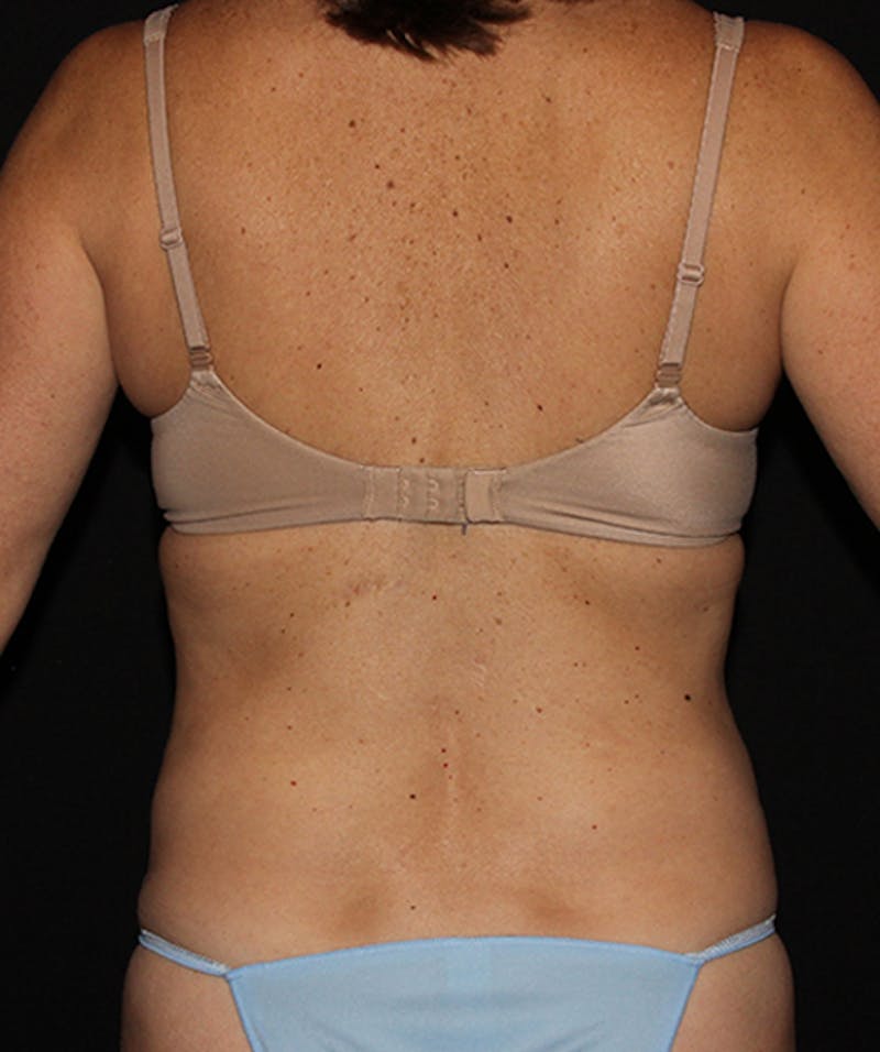 Tummy Tuck Before & After Gallery - Patient 133023942 - Image 12