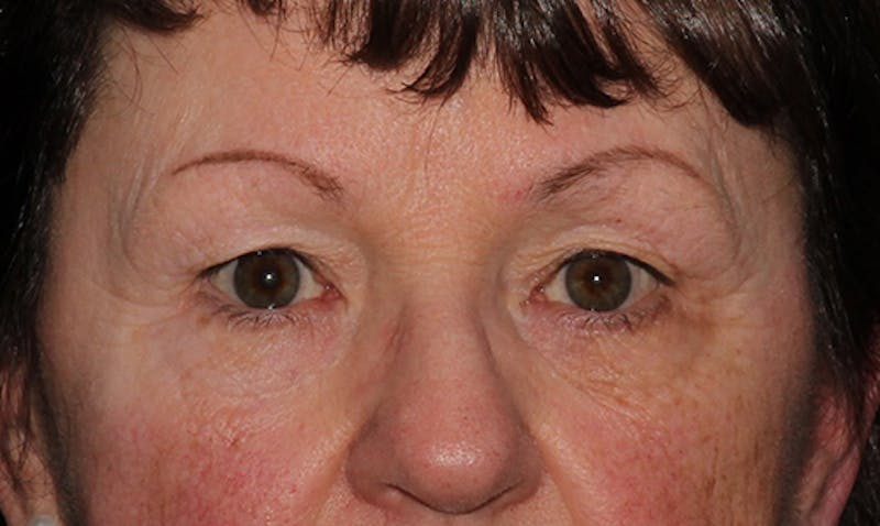 Eyelid Surgery Before & After Gallery - Patient 133023946 - Image 1