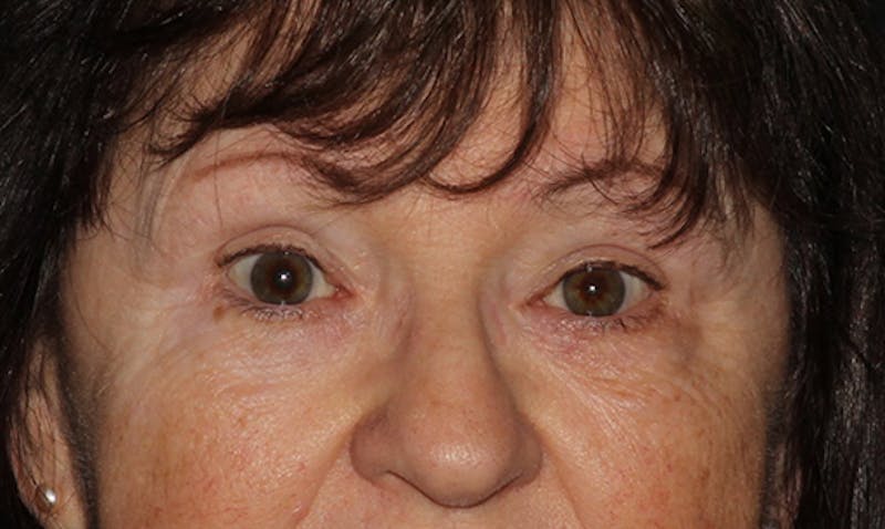 Eyelid Surgery Before & After Gallery - Patient 133023946 - Image 2