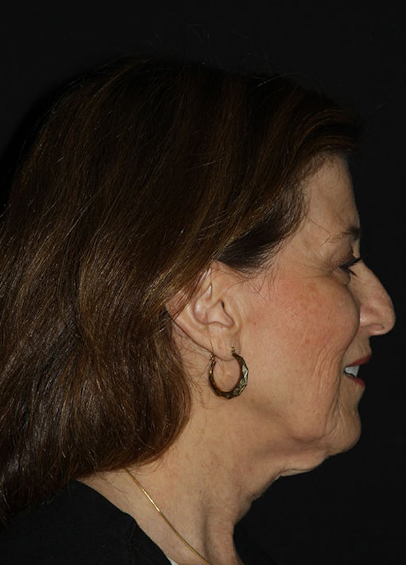 Facelift & Necklift Before & After Gallery - Patient 133023943 - Image 5
