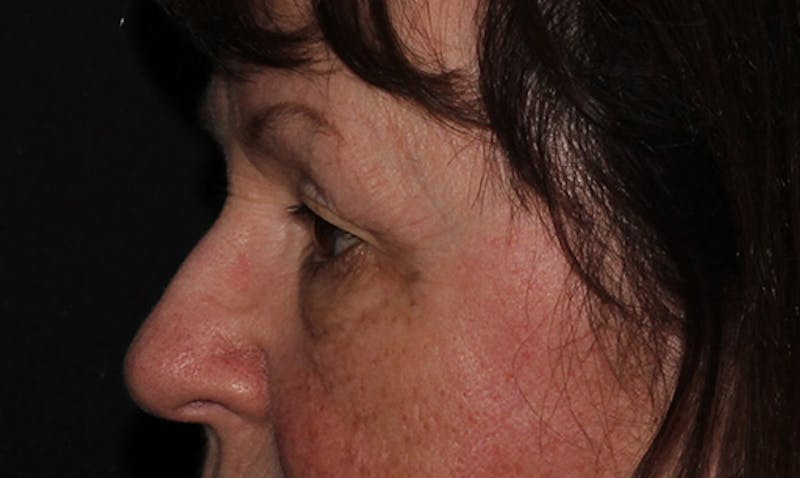 Eyelid Surgery Before & After Gallery - Patient 133023946 - Image 3