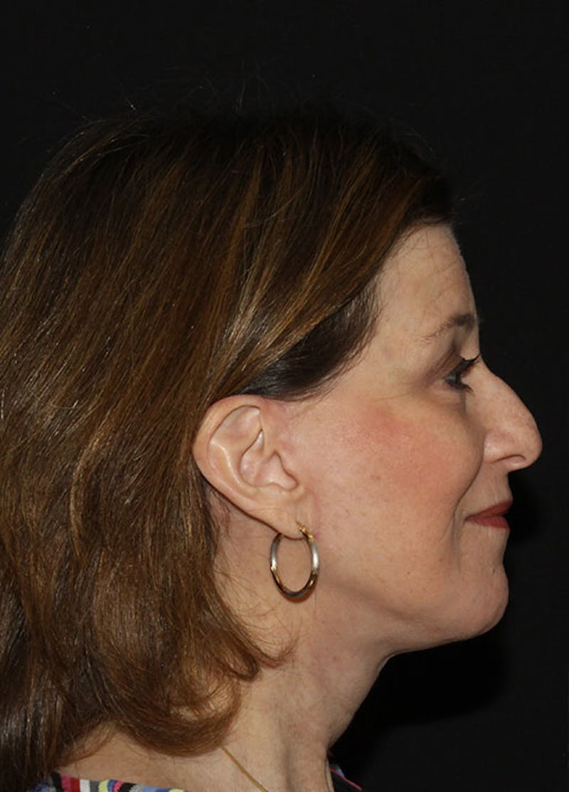 Facelift & Necklift Before & After Gallery - Patient 133023943 - Image 6