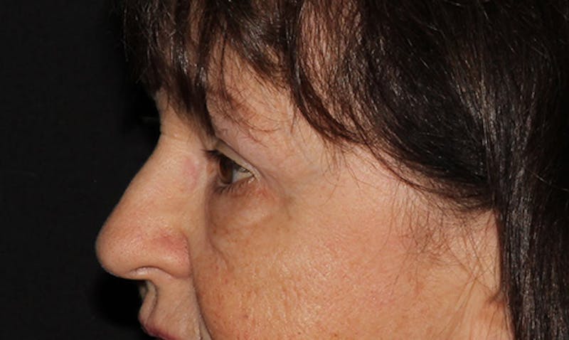 Eyelid Surgery Before & After Gallery - Patient 133023946 - Image 4