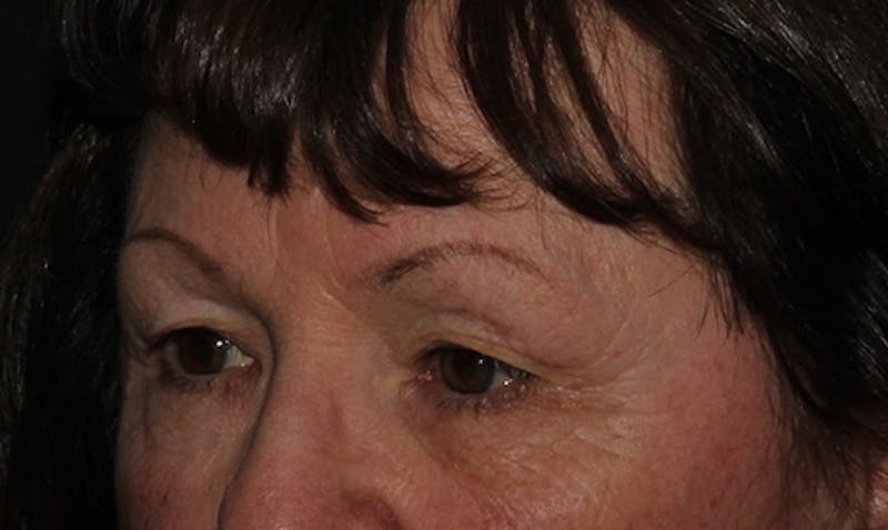 Eyelid Surgery Before & After Gallery - Patient 133023946 - Image 5