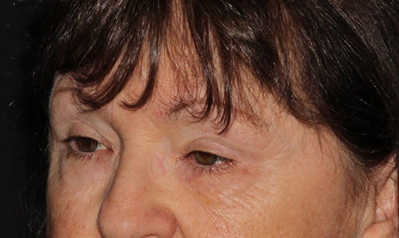 Eyelid Surgery Before & After Gallery - Patient 133023946 - Image 6