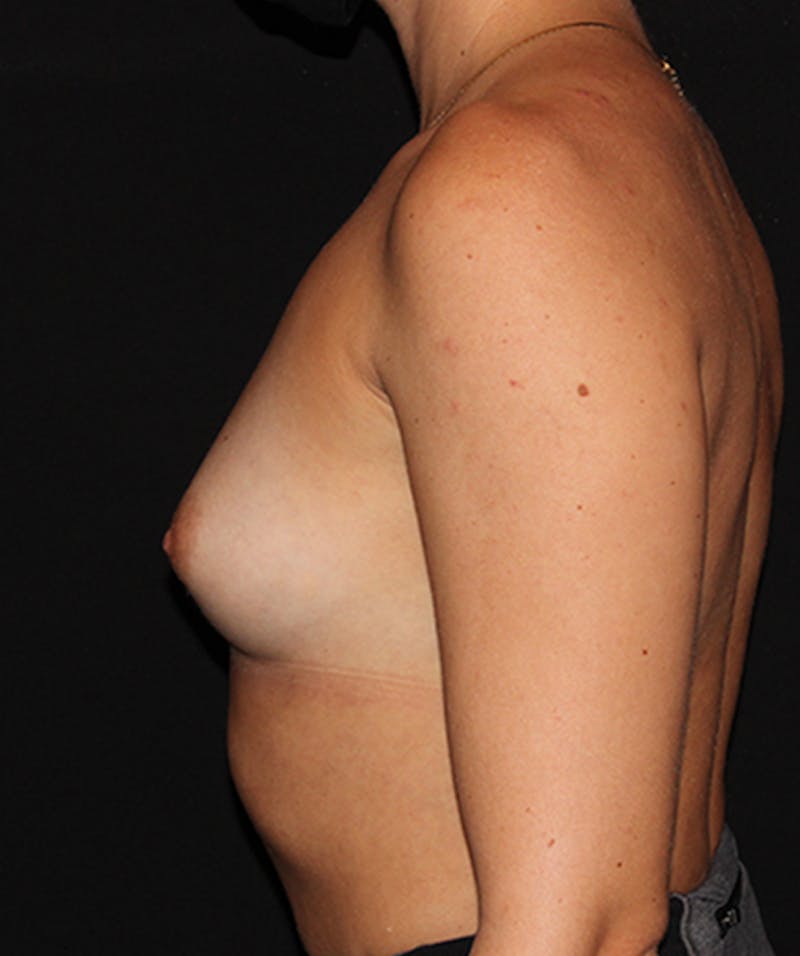 Breast Augmentation Before & After Gallery - Patient 133023948 - Image 5