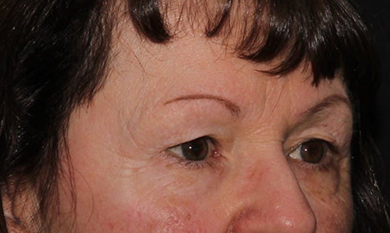 Eyelid Surgery Before & After Gallery - Patient 133023946 - Image 7