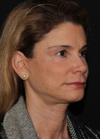 Facelift & Necklift Before & After Gallery - Patient 133023945 - Image 4