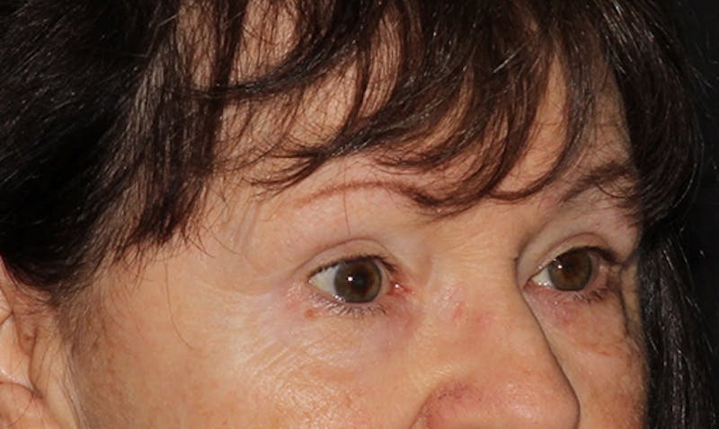 Eyelid Surgery Before & After Gallery - Patient 133023946 - Image 8