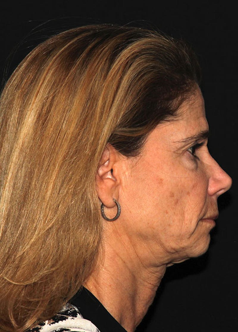 Facelift & Necklift Before & After Gallery - Patient 133023945 - Image 5