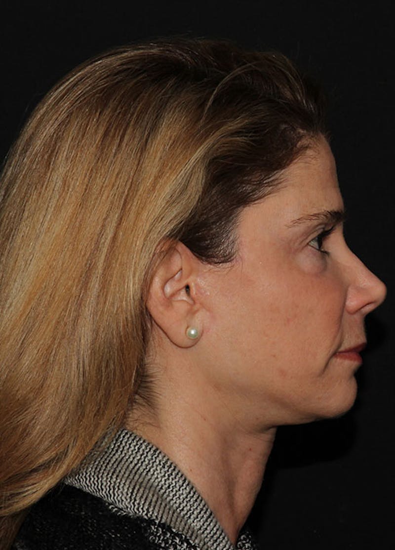 Facelift & Necklift Before & After Gallery - Patient 133023945 - Image 6