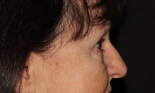 Eyelid Surgery Before & After Gallery - Patient 133023946 - Image 10