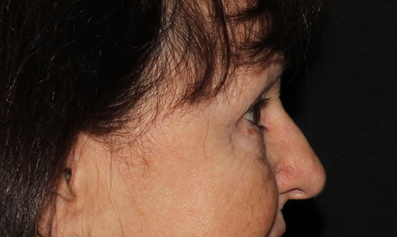 Eyelid Surgery Before & After Gallery - Patient 133023946 - Image 10