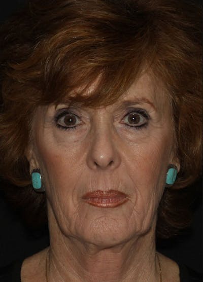 Facelift & Necklift Before & After Gallery - Patient 133023956 - Image 1