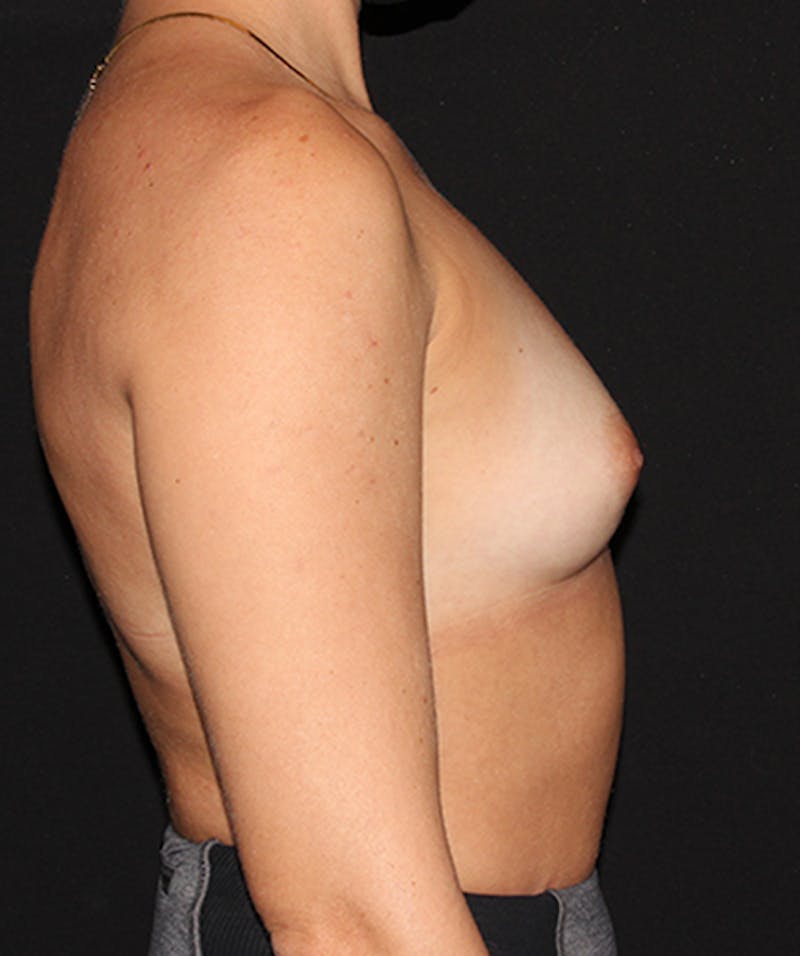 Breast Augmentation Before & After Gallery - Patient 133023948 - Image 9