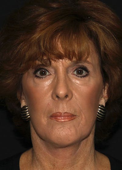 Facelift & Necklift Before & After Gallery - Patient 133023956 - Image 2
