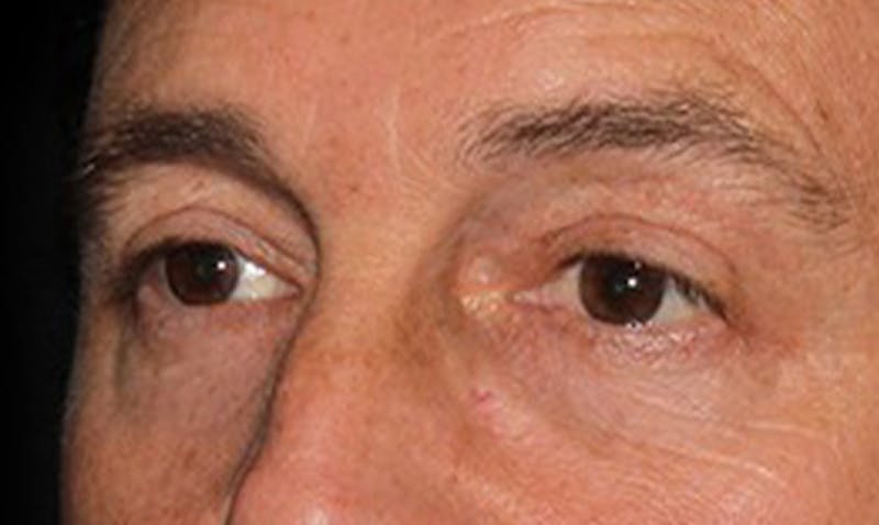 Eyelid Surgery Before & After Gallery - Patient 133023955 - Image 2