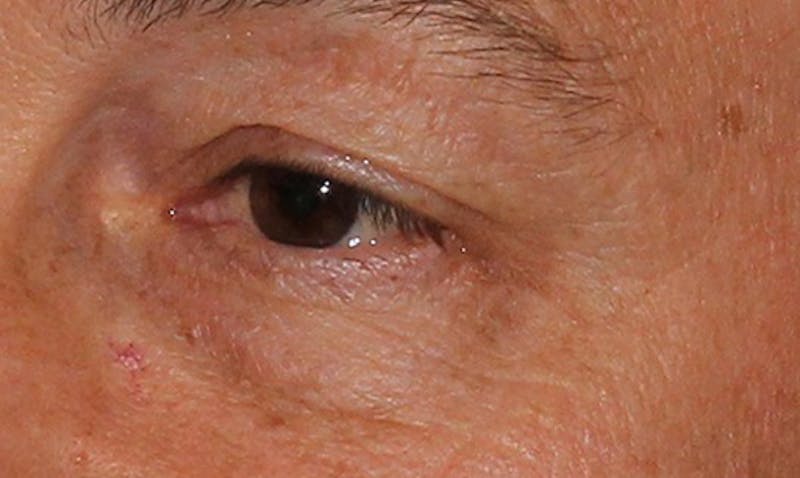 Eyelid Surgery Before & After Gallery - Patient 133023955 - Image 3
