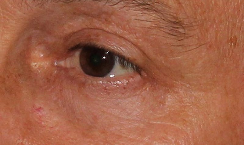 Eyelid Surgery Before & After Gallery - Patient 133023955 - Image 4