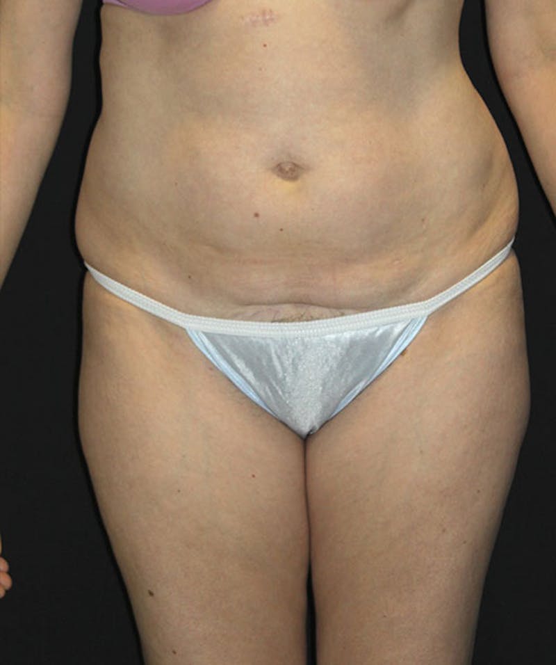 Tummy Tuck Before & After Gallery - Patient 133023963 - Image 1