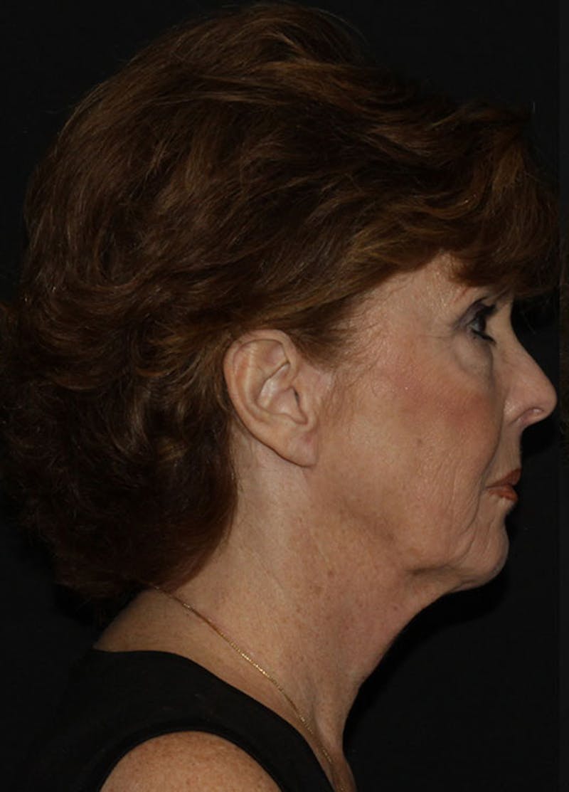 Facelift & Necklift Before & After Gallery - Patient 133023956 - Image 5
