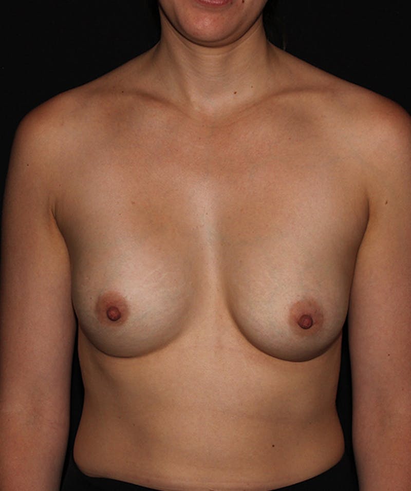 Breast Augmentation Before & After Gallery - Patient 133023966 - Image 2