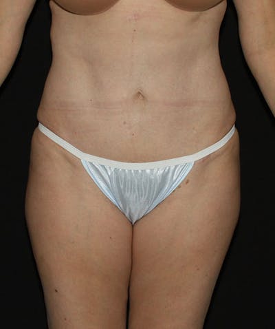 Tummy Tuck Before & After Gallery - Patient 133023963 - Image 2