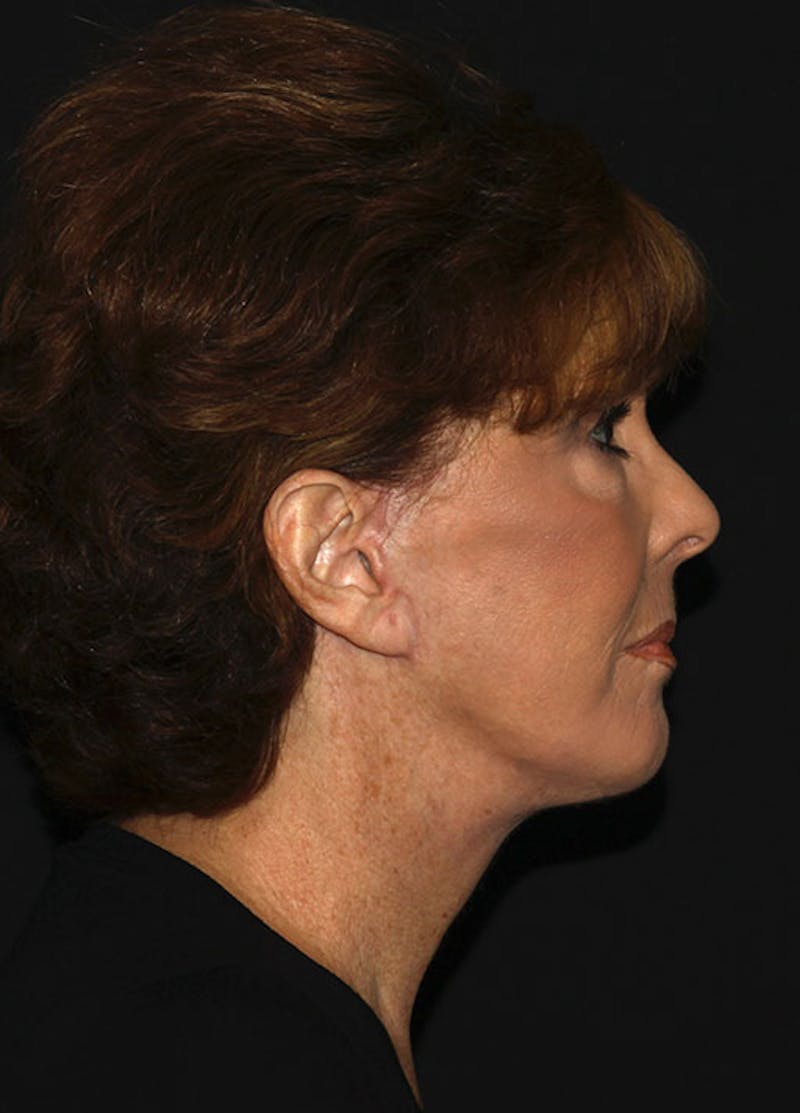 Facelift & Necklift Before & After Gallery - Patient 133023956 - Image 6