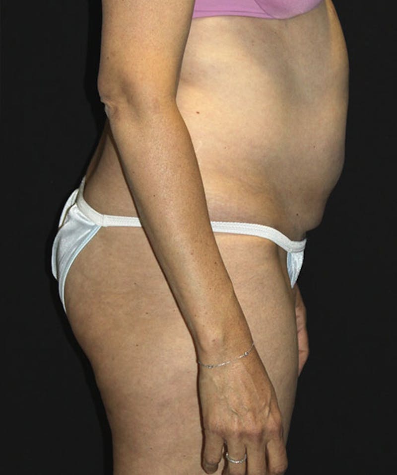 Tummy Tuck Before & After Gallery - Patient 133023963 - Image 3