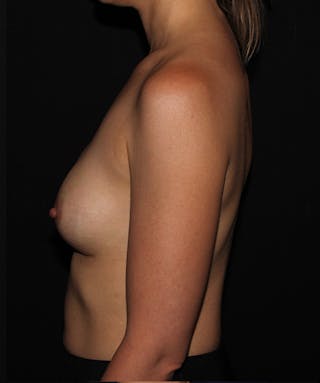 Breast Augmentation Before & After Gallery - Patient 133023966 - Image 4