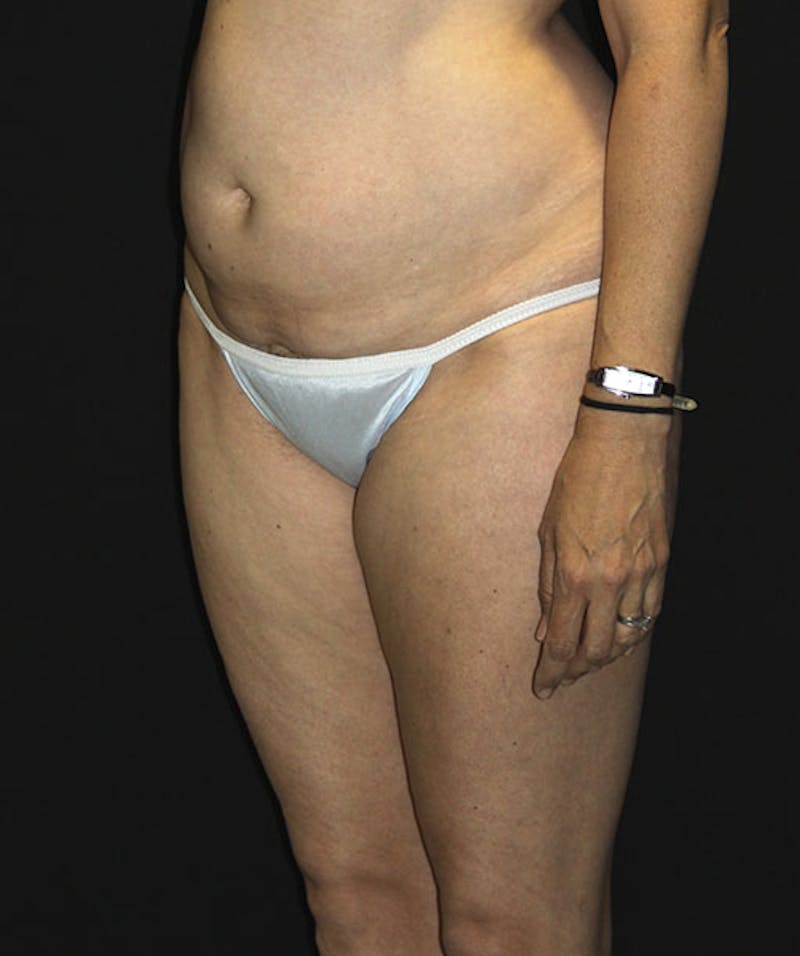 Tummy Tuck Before & After Gallery - Patient 133023963 - Image 5