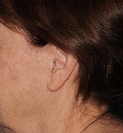 Facelift Scar Before & After Gallery - Patient 133023959 - Image 1