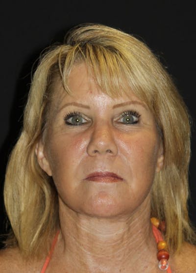 Facelift & Necklift Before & After Gallery - Patient 133023962 - Image 2