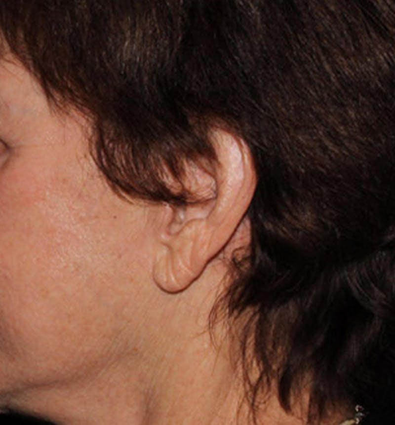 Facelift Scar Before & After Gallery - Patient 133023959 - Image 2