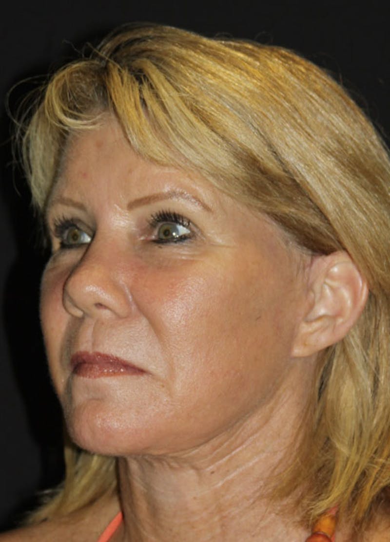 Facelift & Necklift Before & After Gallery - Patient 133023962 - Image 4