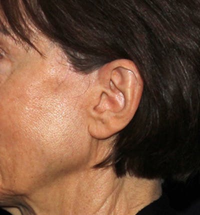 Facelift Scar Before & After Gallery - Patient 133023964 - Image 1